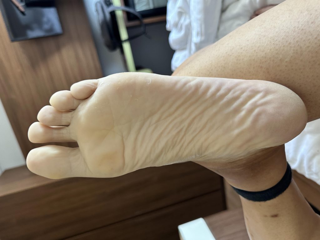 捆绑血液不流通的阶段变化