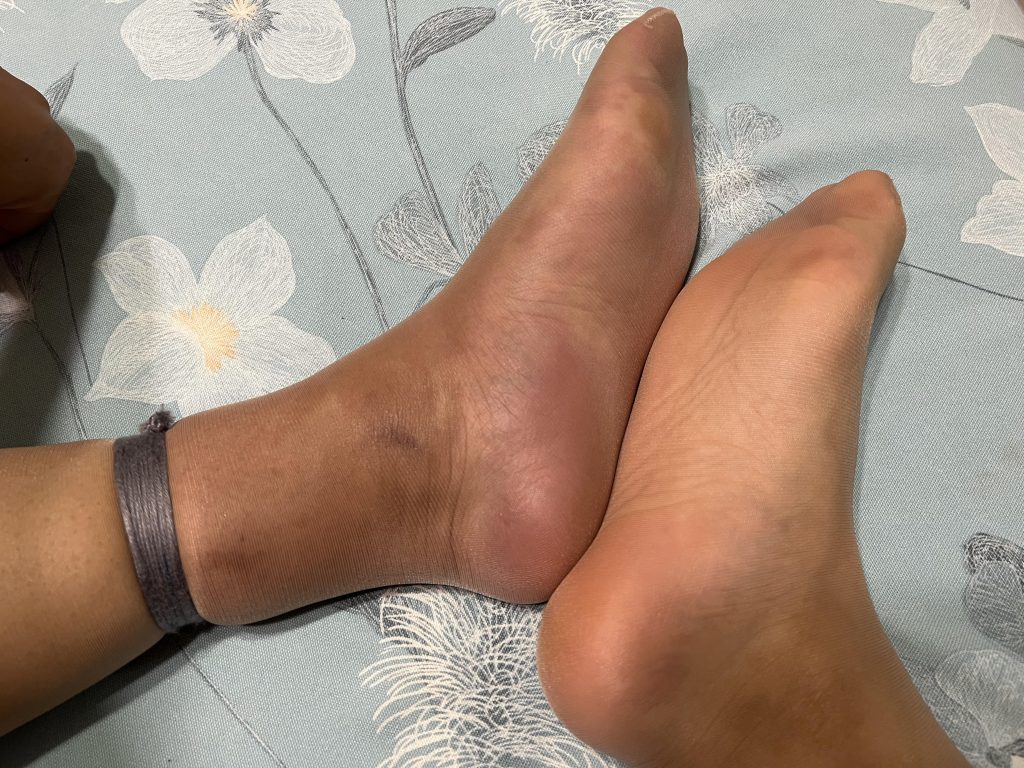 小小的皮筋脚都给我勒肿了