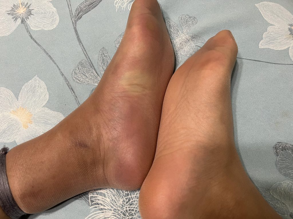 小小的皮筋脚都给我勒肿了